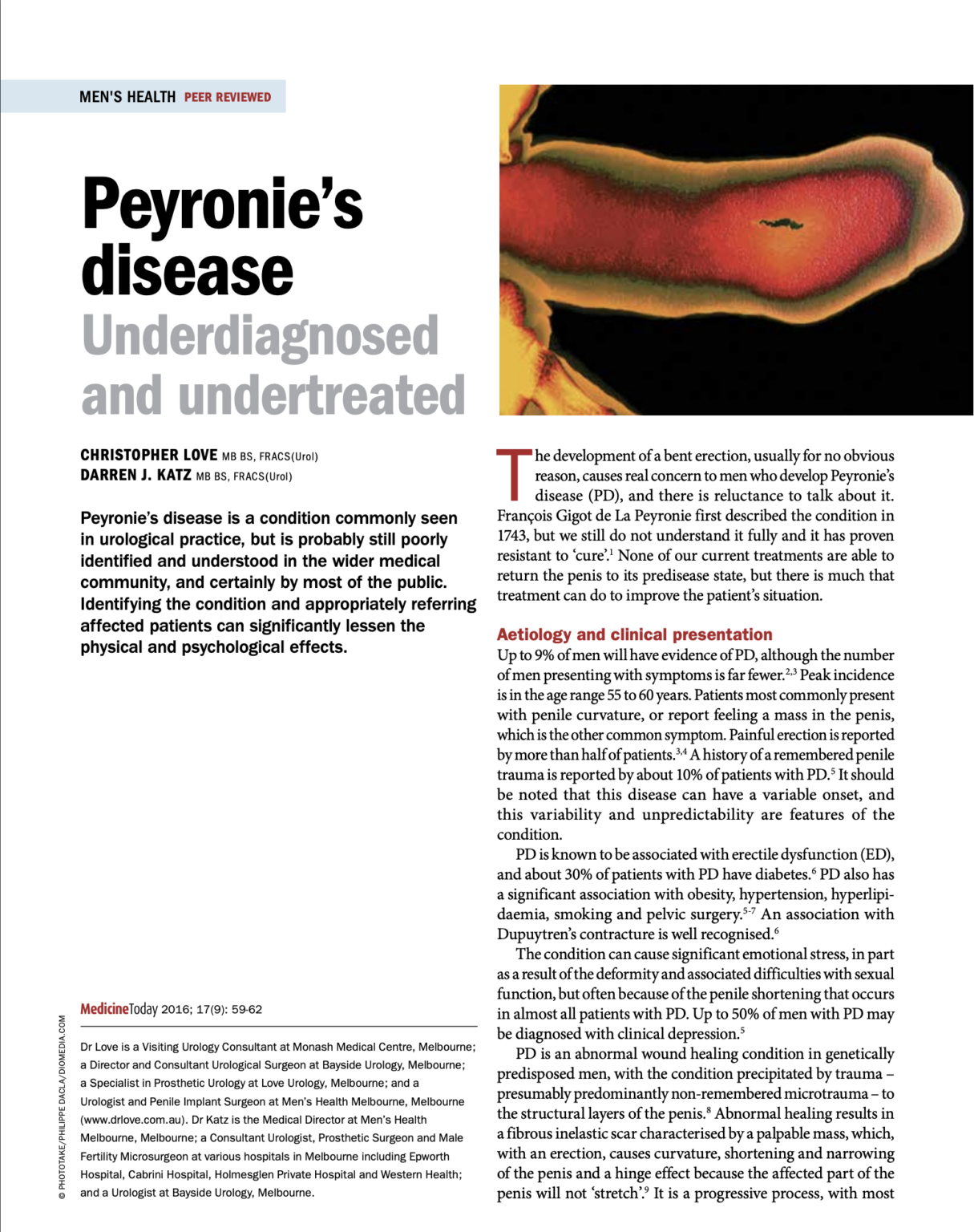 Peyronie's Disease Underdiagnosed and Untreated Dr Love